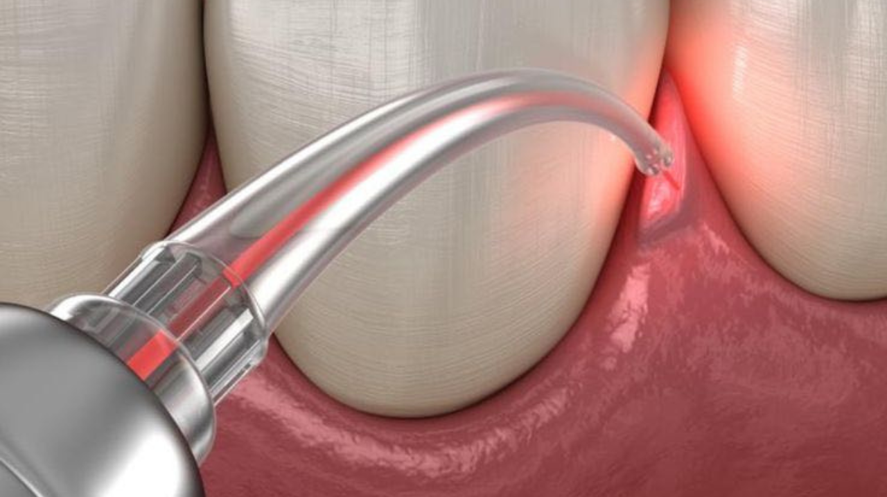 Laser Dentistry